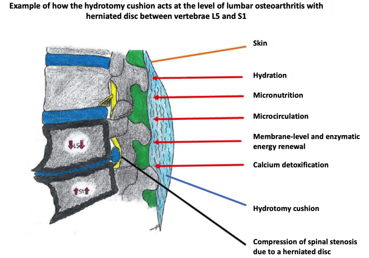 Sketch showing placement of a hydrotomy cushion