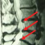 Herniated disc